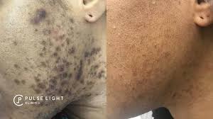 Ingrown hair is a common condition that results from hair removal. Ingrown Hair Removal Pulse Light Clinic London