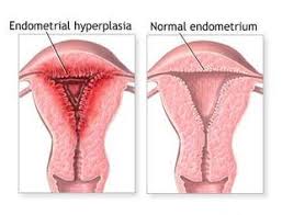 Bagaimana penebalan dinding rahim bisa terjadi sepanjang siklus menstruasi? Ria Buchari Hiperplasia Endometrium