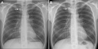 Image result for lung cancer xray
