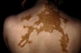 Pityriasis alba on the cheek. Vitiligo Erkrankungen Der Haut Msd Manual Profi Ausgabe