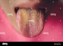 Image result for yellow tongue infection