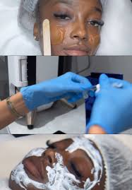 #skinbrightning #mesotherapy