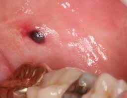 Blisters in mouth and cheeks. Blood Blister In Cheek Inside Causes No Pain Cancer Mouth Red Treatment Small Cheek Blisters Pictures