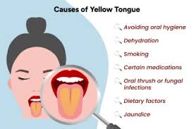 Image result for yellow tongue infection