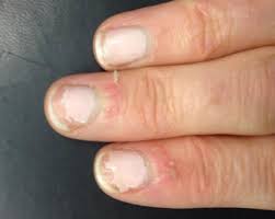 How can i keep myself from biting my nails? This Is Why You Should Stop Biting The Skin Off Round Your Fingernails Immediately