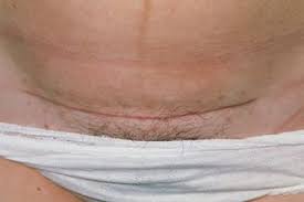 You should expect to need help. Caesarean Section Recovery Nhs