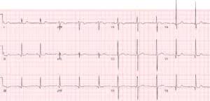 Image result for Pericarditis