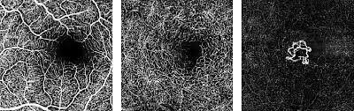 Automate data extraction from websites within point, click and extract. Heidelberg Engineering Oct Angiography Module Now Available In The United States Heidelberg Engineering Inc