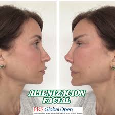 NO a estos resultados!!!! ¡La estética tiende a avanzar hacia ideales más  estilizados y naturales por lo que este resultado es una aberración! 🌟✨ El  término “alienización” en prácticas estéticas se refiere