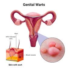 Image result for genital warts