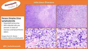 774,117 likes · 16,616 talking about this. Herpes Simplex Virus Lymphadenitis Expanded Paracortex Grepmed