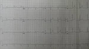 • it is the inflammation of the outer serosa of heart in rheumatism. Acute Pericarditis Wikipedia