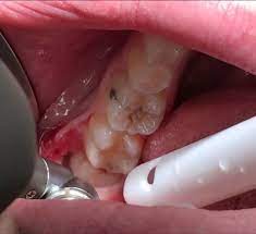 Every tooth is invaluable to your oral health and functions, but there are 4 teeth that commonly need to be removed. 3rd Molar Extractions Wisdom Teeth Removal Cost And Prices In Mexico 2019