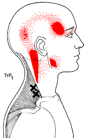 Trigger Point Therapy That Is How We Treat Pain