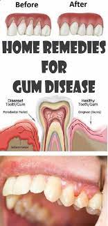 Home Remedies For Gum Disease Gum Disease Remedies Gum Inflammation Healthy Teeth