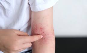 Image result for Atopic Dermatitis