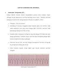 Namun, ada komponen lain yang harus kita pahami bila ingin membaca ekg dengan baik. Contoh Gambaran Ekg Abnormal