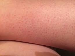 The Easiest Ways To Get Rid Of Strawberry Legs At Home Strawberry Legs Dark Pores Shaving Legs