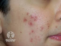 Image result for acne face