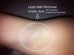 What you need to know about laser hair removal 1. Does Laser Hair Removal Really Work Does Laser Hair Removal Really Work