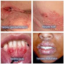 Welcome to read the docs. Cara Mengobati Herpes Agar Sembuh Tuntas