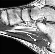 6 mri is commonly ordered in the diabetic patient to rule out infection in the presence of an ulcer, to evaluate the severity of charcot arthropathy. Plantar Fasciitis Radsource