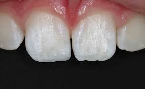 Bei uns günstig & bequem online bestellen. White Fillings Frequently Asked Questions Composite Fillings Before After