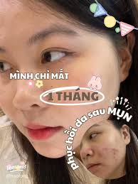 Hành trình 1 tháng phục hồi da sau mụn 🍋✨