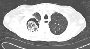 Along with cns cryptococcosis, it is one of the most common fungal opportunistic infections of the central nervous system. Pulmonary Aspergillosis A Clinical Review European Respiratory Society