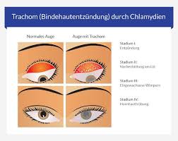 Die symptome bei chlamydien sind oft nicht eindeutig, aber sehr gefährlich. Chlamydien Symptome Behandlung Der Geschlechtskrankheit