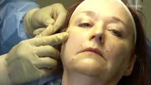 Controversial cosmetic procedure once banned by FDA returns
