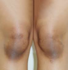 This is the new ebay. Dark Knees No More Skin Lightening Treatment For Dark Elbows Knees