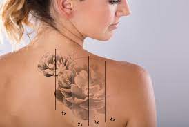 When you pay to have a tattoo removed by us, you give a free tattoo removal to someone whose past choices are in the way of a brighter future—because a past record shouldn't mean a life sentence. Laser Tattoo Removal