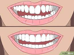 You'll also have access to our 24/7 support and dental teams via video chat, phone, or email if you have any. How To Straighten Your Teeth Without Braces With Pictures