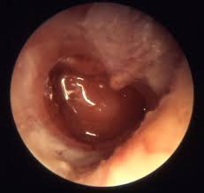 Image result for Acute Otitis Externa