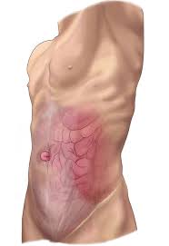 Check spelling or type a new query. Sports Hernia Johns Hopkins Medicine