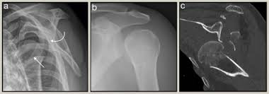 Image result for Shoulder Imaging
