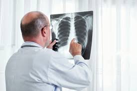 People who already have symptoms that might be caused by lung cancer may need tests such as ct scans to find the underlying cause, which in some cases may be cancer. New Ct Scan For Lung Cancer Bluegrass Regional Imaging