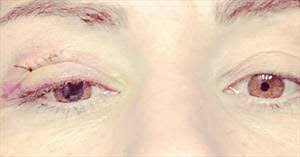 Tko (eye injury) 1 1:01 bantamweight petr yan: Cat Zingano Says She Has Damage To Her Eye After Ufc 232 Fight Considers Appeal Page 3 Sherdog Forums Ufc Mma Boxing Discussion