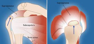 Image result for Rotator Cuff Injury