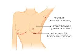 Improperly fitted breast implants produce poor results — diligently carrying out the breast. Breastfeeding With Implants Breastfeeding Support
