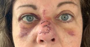 The nose poses a series of unique challenges in respect to skin cancers. What Are Signs Of Melanoma Woman Hopes To Raise Awareness By Sharing Story Of Freckle