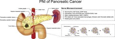The cancer may not always alter blood sugar levels enough to show signs of diabetes. New Insights Into Perineural Invasion Of Pancreatic Cancer More Than Pain Sciencedirect