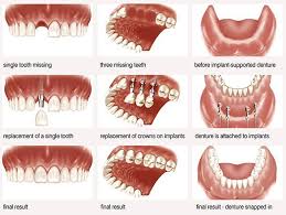 The costs of dental implants are determined by many factors. How To Get Complete Information On Dental Implants Dental Implants Cost Tooth Implant Cost Teeth Implants