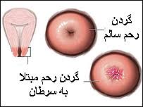 Image result for â«Ø³Ø±Ø·Ø§Ù Ú¯Ø±Ø¯Ù Ø±Ø­Ùâ¬â
