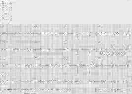 Q waves of 0.04 seconds (1 mm) duration and greater than one third the r wave's amplitude in the same lead may be pathological. Pathological Q Waves Ecg Guru Instructor Resources