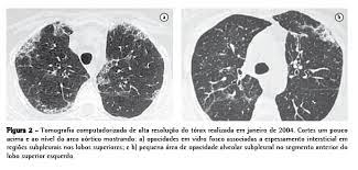 A segunda mais comum em termos de bactérias; Jornal Brasileiro De Pneumologia Pneumonia Eosinofilica Cronica Secundaria Ao Uso Prolongado De Nitrofurantoina Achados Da Tomografia Computadorizada De Alta Resolucao Do Torax