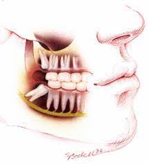 Wisdom Teeth Dental Excellence