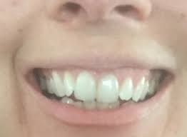 How Can I Fix A Canted Smile? (Photos)