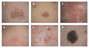 Melanoma, another type of skin cancer, arises in the pigment cells (melanocytes). Examples Of Melanoma And Non Melanoma Skin Cancer Taken In A Clinical Download Scientific Diagram